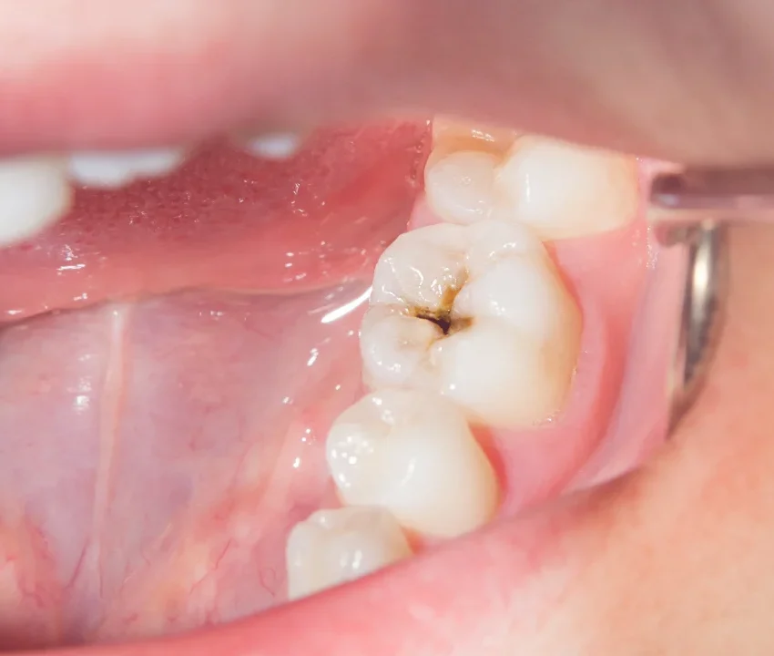 cavity