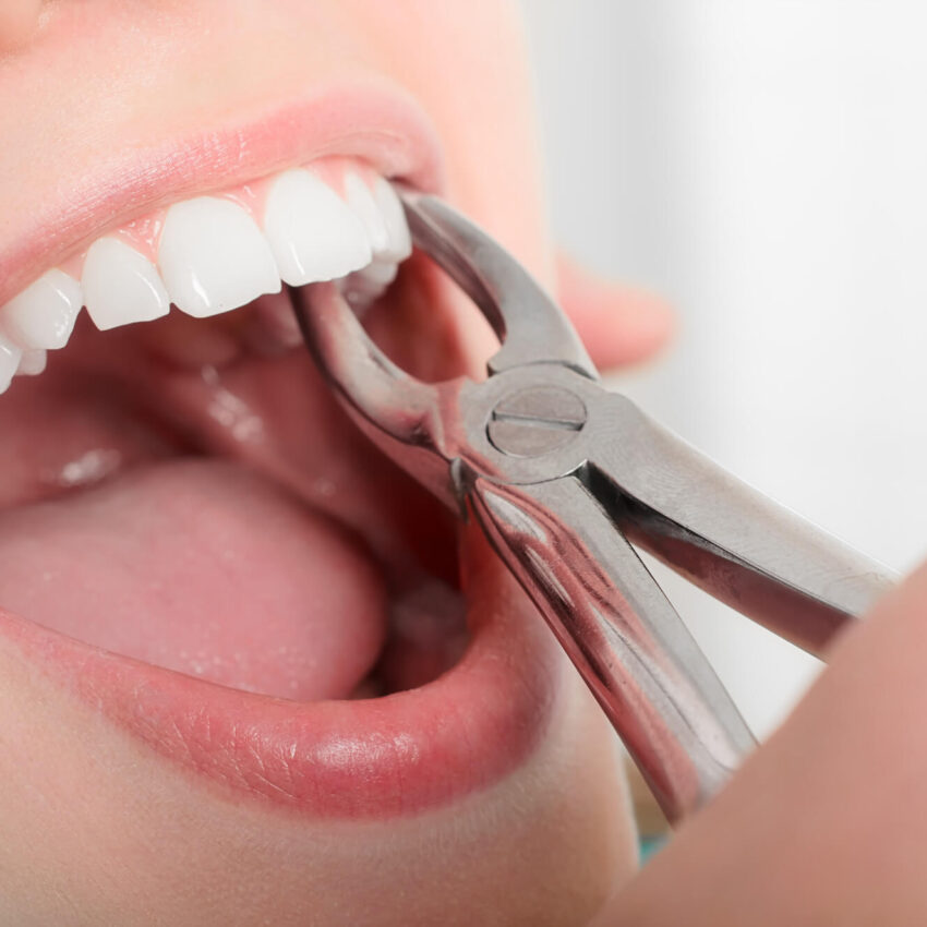 is-a-tooth-extraction-painful